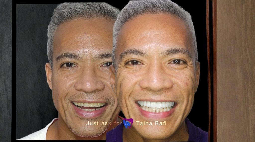 How Long Does Teeth Whitening Last