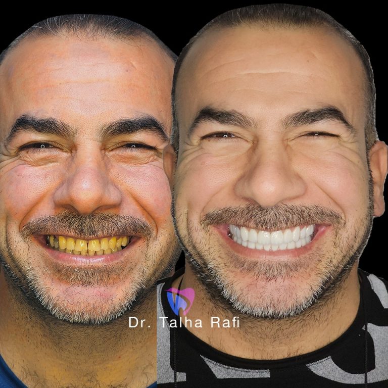 before after 8