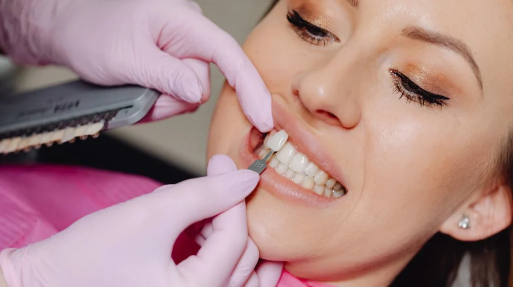 Teeth Bonding vs Veneers