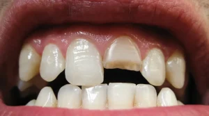 broken tooth